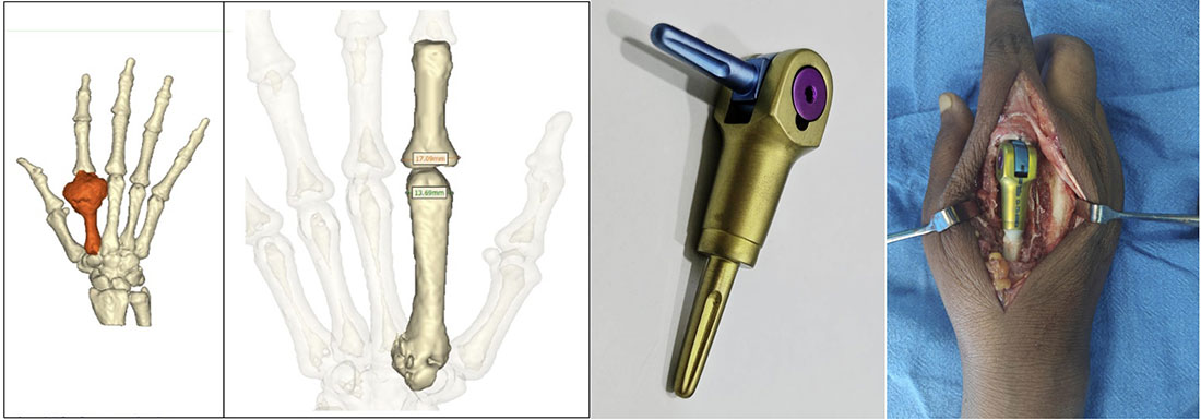 Customized 3D-printed implants allow precise reconstruction after bone tumor removal at rare and challenging anatomical sites Customized 3D-printed implants allow precise reconstruction after bone tumor removal at rare and challenging anatomical sites
