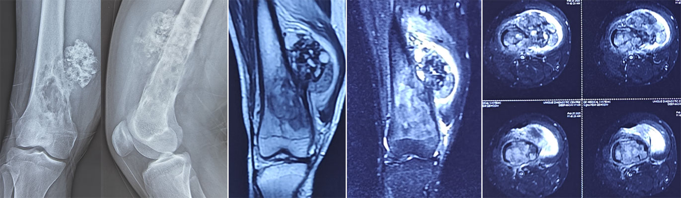 Dedifferentiated chondrosarcoma Dedifferentiated chondrosarcoma