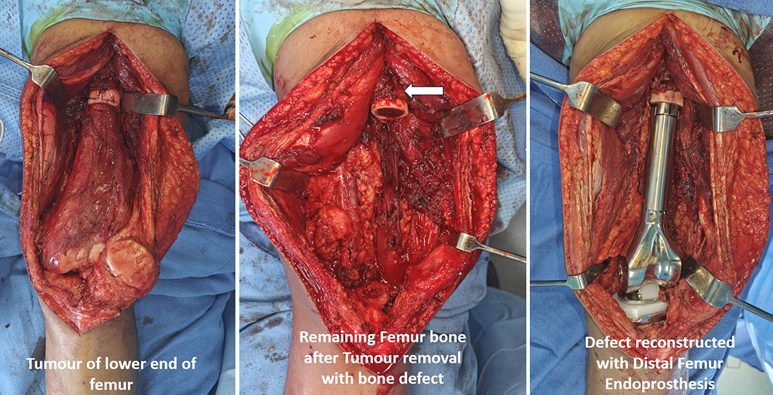 Distal Femur Tumor – Limb-Salvage Reconstruction Distal Femur Tumor – Limb-Salvage Reconstruction