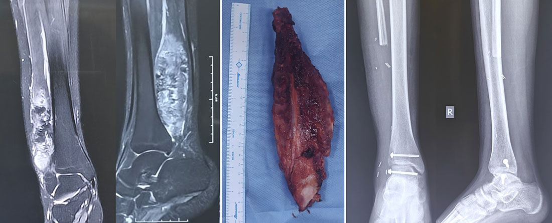 Distal Fibula Osteosarcoma Distal Fibula Osteosarcoma
