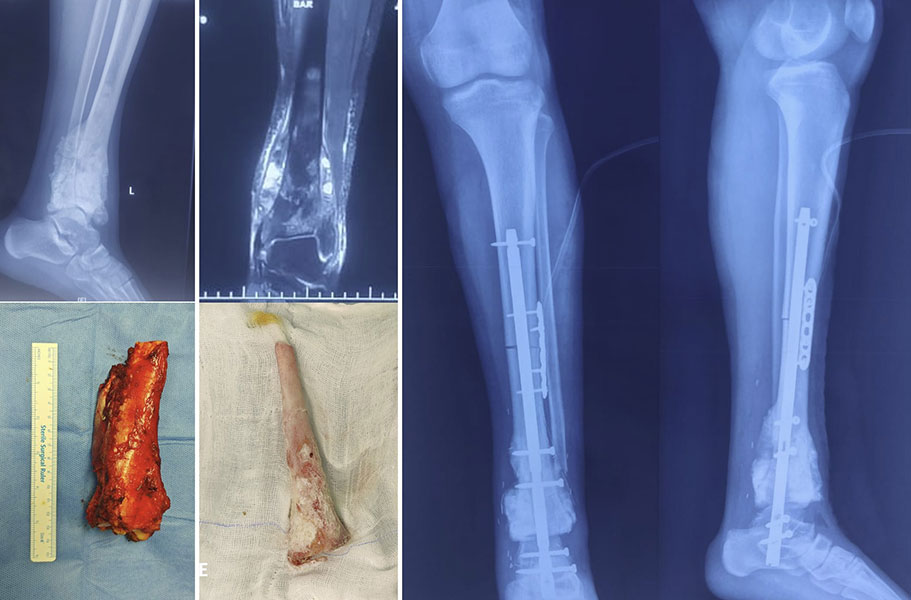 Distal Tibia Osteosarcoma — Extracorporeal Irradiation Distal Tibia Osteosarcoma — Extracorporeal Irradiation
