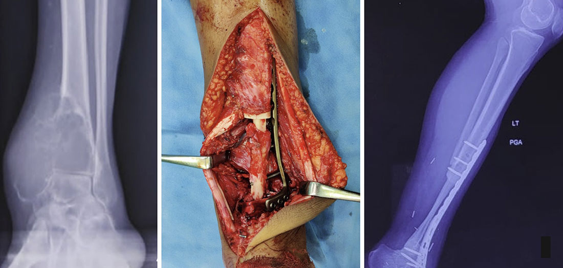 Distal Tibia Resection, Fibular Reconstruction & Ankle Fusion Distal Tibia Resection, Fibular Reconstruction & Ankle Fusion