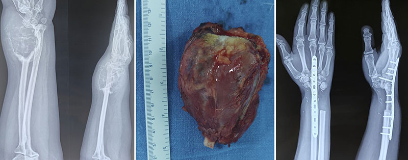 Distal radius tumor resection with ulna translocation and wrist fusion Distal radius tumor resection with ulna translocation and wrist fusion