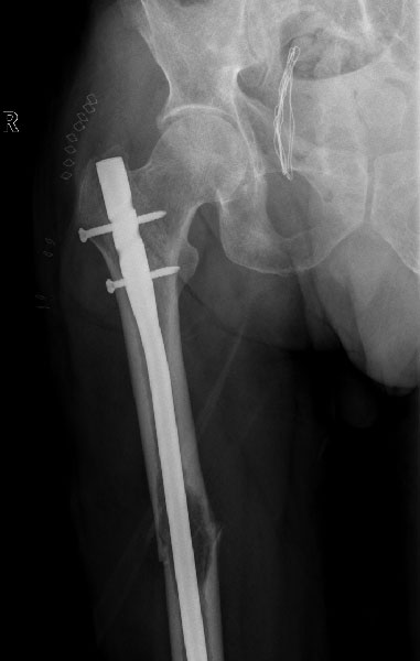 Early treatment of an impending fracture can prevent the pain and disability of a complete fracture Early treatment of an impending fracture can prevent the pain and disability of a complete fracture