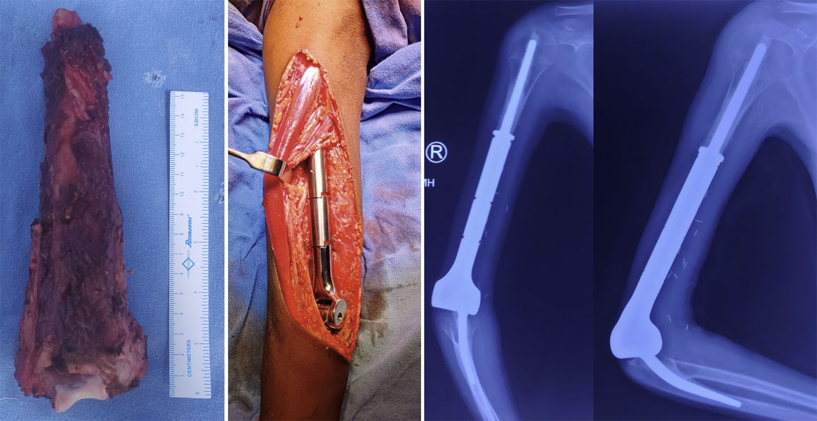 Elbow reconstruction with an endoprosthesis after wide resection of the humeral tumor, designed to preserve elbow movement and arm function