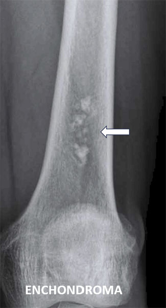 Enchondroma of the femur Enchondroma of the femur