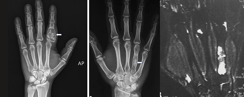 Enchondroma of the hand Enchondroma of the hand
