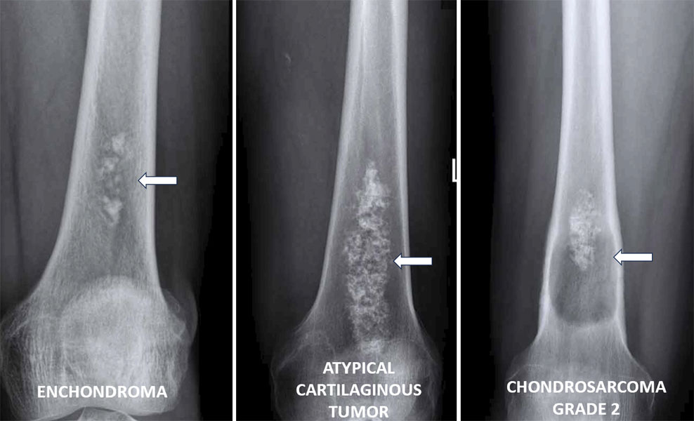 Enchondroma vs atypical cartilaginous tumor vs chondrosarcoma Enchondroma vs atypical cartilaginous tumor vs chondrosarcoma