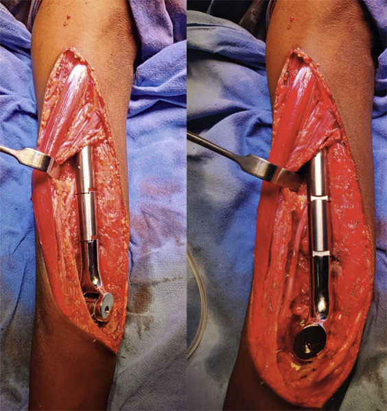 Endoprosthetic elbow reconstruction after tumor resection around the elbow, helping restore stability and useful elbow movement