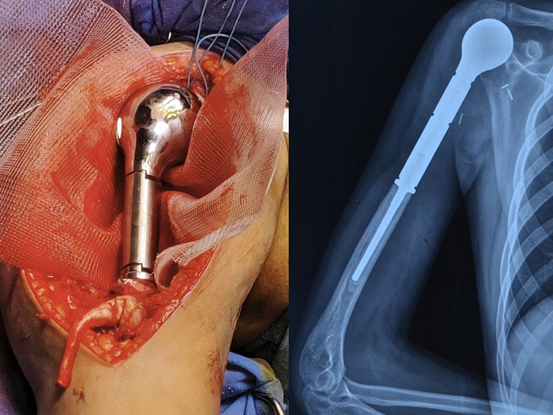 Endoprosthetic reconstruction of the proximal humerus after tumor removal as part of limb-salvage surgery Endoprosthetic reconstruction of the proximal humerus after tumor removal as part of limb-salvage surgery