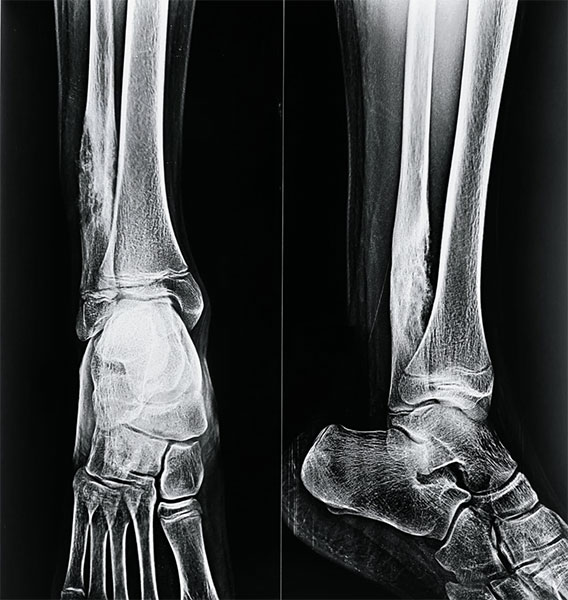 Ewing sarcoma of the ankle and foot—a malignant bone tumor requiring specialized oncological management Ewing sarcoma of the ankle and foot—a malignant bone tumor requiring specialized oncological management