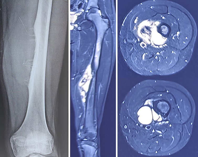 Ewing sarcoma of the femur with the tumor identified on X-ray and MRI before limb-salvage surgery Ewing sarcoma of the femur with the tumor identified on X-ray and MRI before limb-salvage surgery