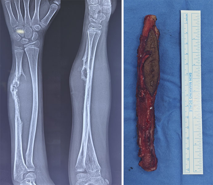 Ewing sarcoma of the forearm bone (radius) 
