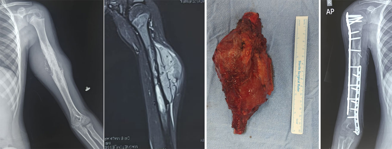 Ewing sarcoma of the humerus in an 8-year-old girl treated with chemotherapy and wide tumor resection