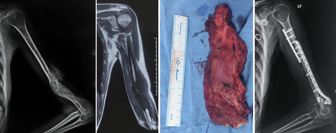 Ewing sarcoma of the humerus treated with wide tumor resection and biological reconstruction using a non-vascularized fibular graft Ewing sarcoma of the humerus treated with wide tumor resection and biological reconstruction using a non-vascularized fibular graft