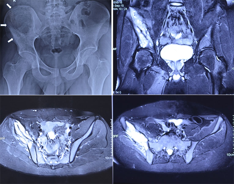 Ewing sarcoma of the pelvis Ewing sarcoma of the pelvis