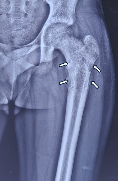 Ewing sarcoma of the proximal femur with an extensive tumor involving the bone and surrounding tissues Ewing sarcoma of the proximal femur with an extensive tumor involving the bone and surrounding tissues