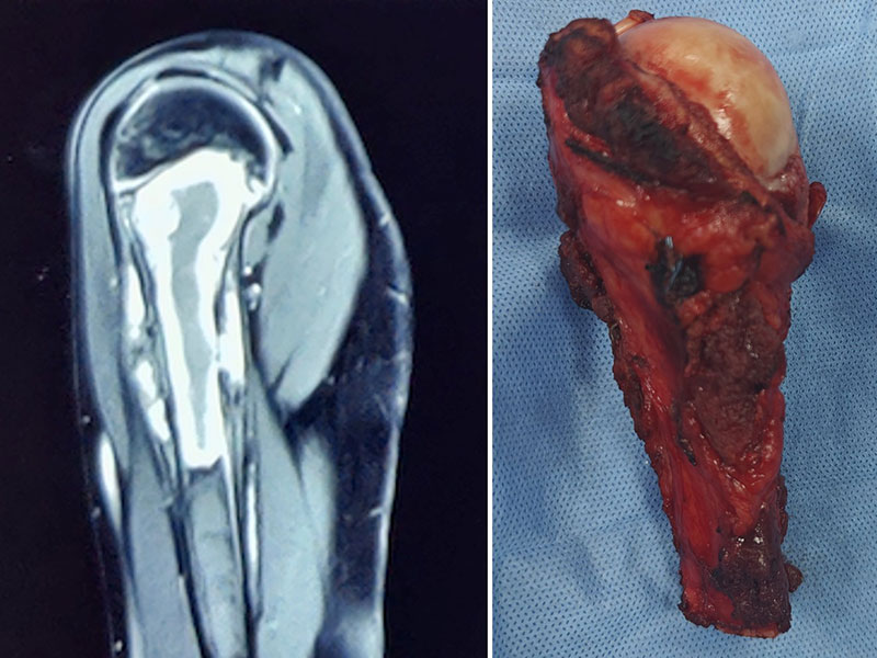 Ewing sarcoma of the proximal humerus treated with wide tumor resection and limb-salvage surgery Ewing sarcoma of the proximal humerus treated with wide tumor resection and limb-salvage surgery