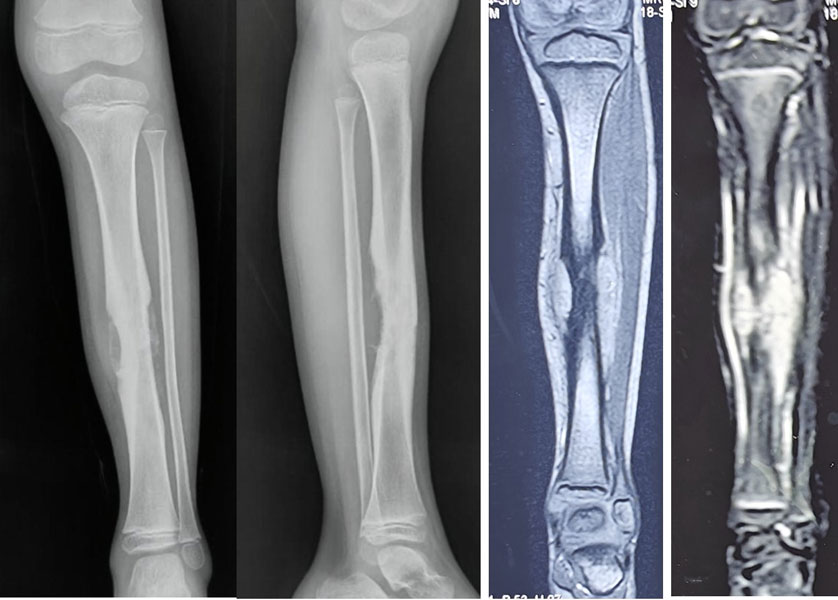 Ewing sarcoma of the shin bone (tibia) Ewing sarcoma of the shin bone (tibia)