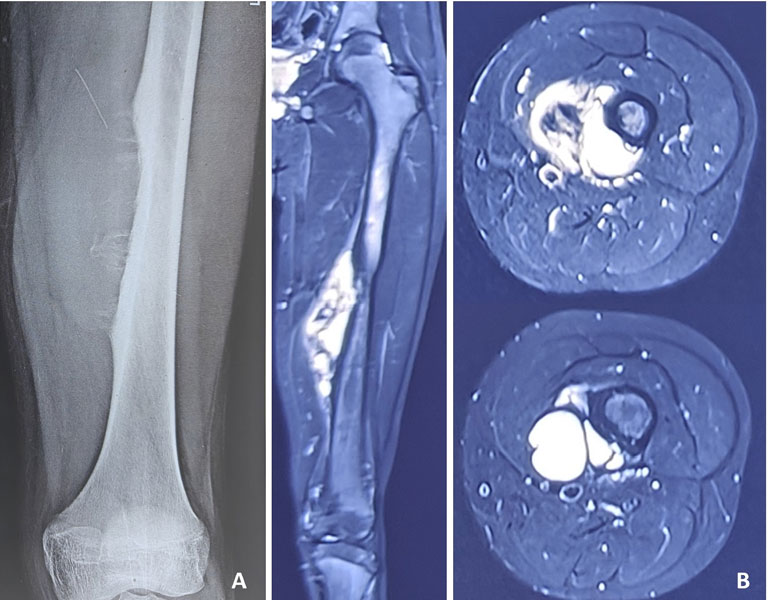Ewing sarcoma of the thigh bone (femur)