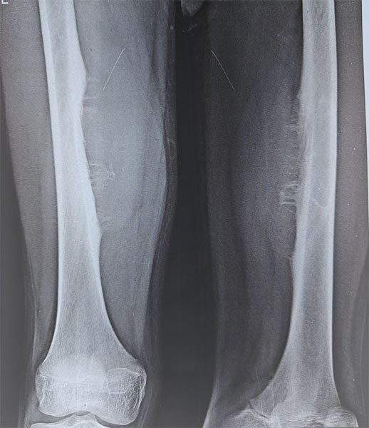 Ewing sarcoma of the thigh bone (femur)