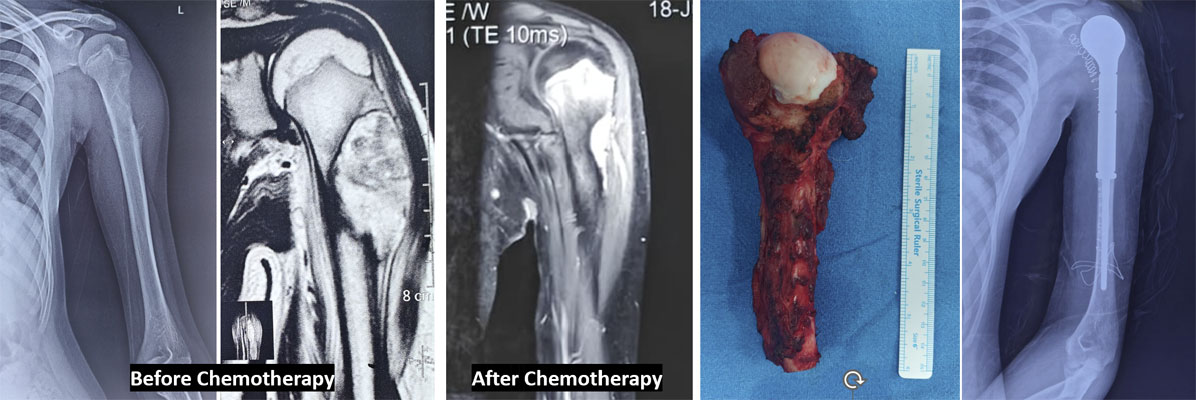 Ewing sarcoma of the upper arm bone (humerus) 