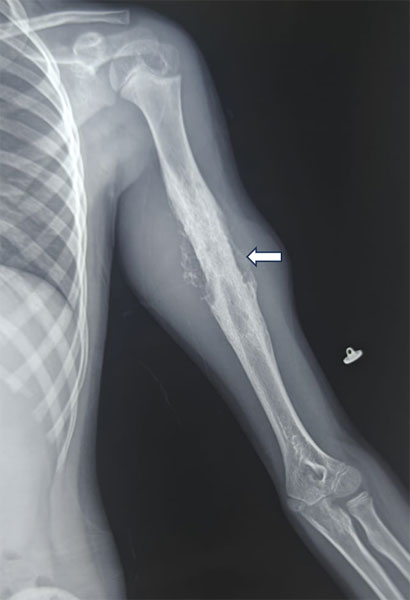 Ewing sarcoma of the arm bone (humerus) Ewing sarcoma of the arm bone (humerus)