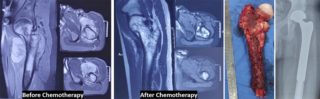 Ewing sarcoma of the upper thigh bone (proximal femur) 