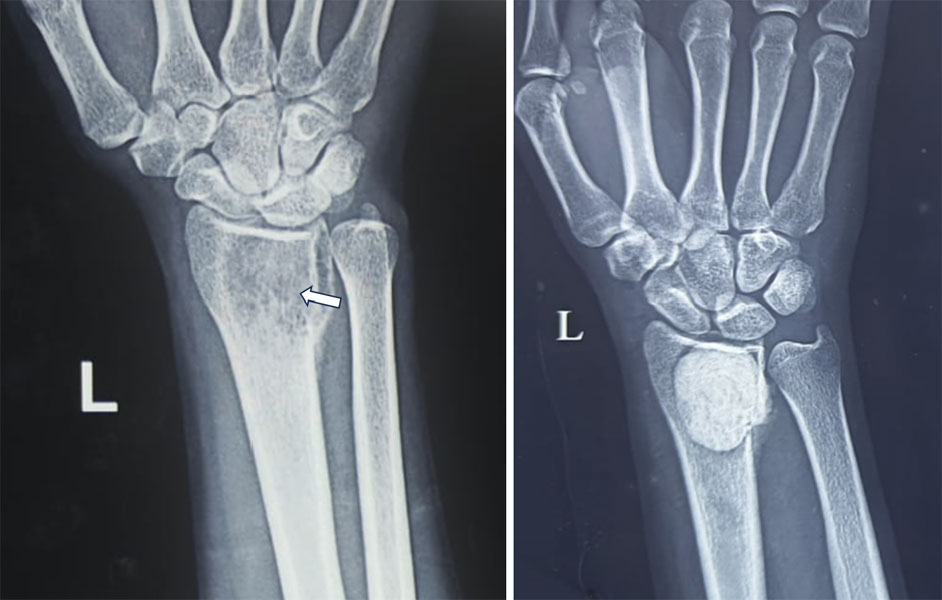 Extended curettage for a giant cell tumor of bone, followed by reconstruction of the resulting bone defect Extended curettage for a giant cell tumor of bone, followed by reconstruction of the resulting bone defect