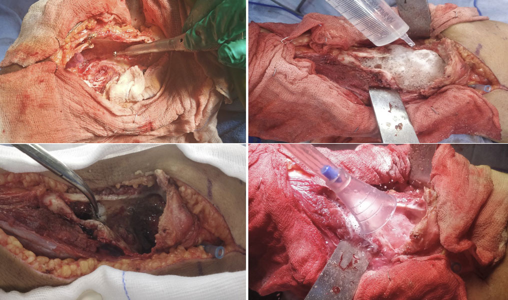 Extended curettage using a high-speed burr, chemical adjuvants and thorough lavage to reduce the risk of residual tumor cells Extended curettage using a high-speed burr, chemical adjuvants and thorough lavage to reduce the risk of residual tumor cells