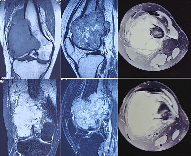 Extensive Grade 3 giant cell tumor around the knee Extensive bone destruction caused by a Grade 3 giant cell tumor around the knee