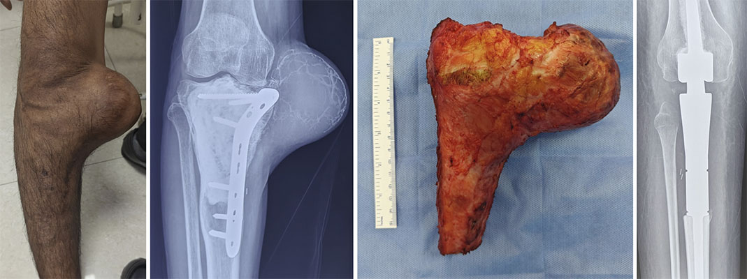 Extensive recurrence may require wide resection and reconstruction Extensive recurrence may require wide resection and reconstruction