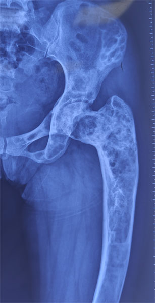 Fibrous dysplasia causing deformity of the femur Fibrous dysplasia causing deformity of the femur