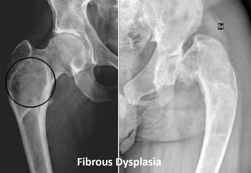 Fibrous dysplasia of the femur Fibrous dysplasia of the femur