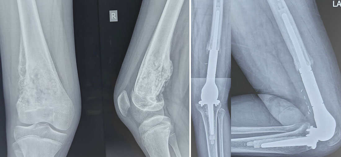 From Bone Tumor to Limb Salvage From Bone Tumor to Limb Salvage