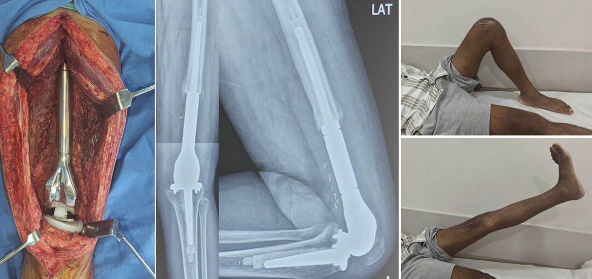 Functional recovery after osteosarcoma surgery Functional recovery after osteosarcoma surgery