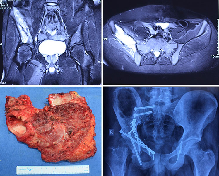 Giant Cell Tumour — Curettage Giant Cell Tumour — Curettage