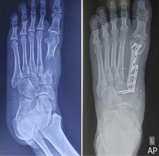 Giant Cell Tumour of the First Metatarsal Giant Cell Tumour of the First Metatarsal