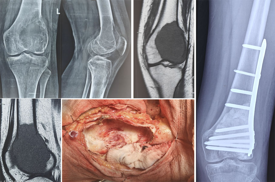 Giant cell tumor around the knee treated with extended curettage and bone cement reconstruction, preserving the native joint Giant cell tumor around the knee treated with extended curettage and bone cement reconstruction, preserving the native joint