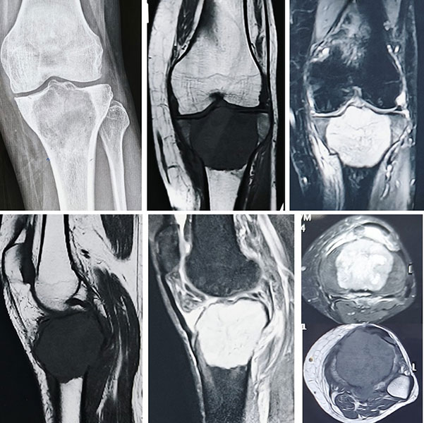 Giant cell tumor around the knee Giant cell tumor around the knee