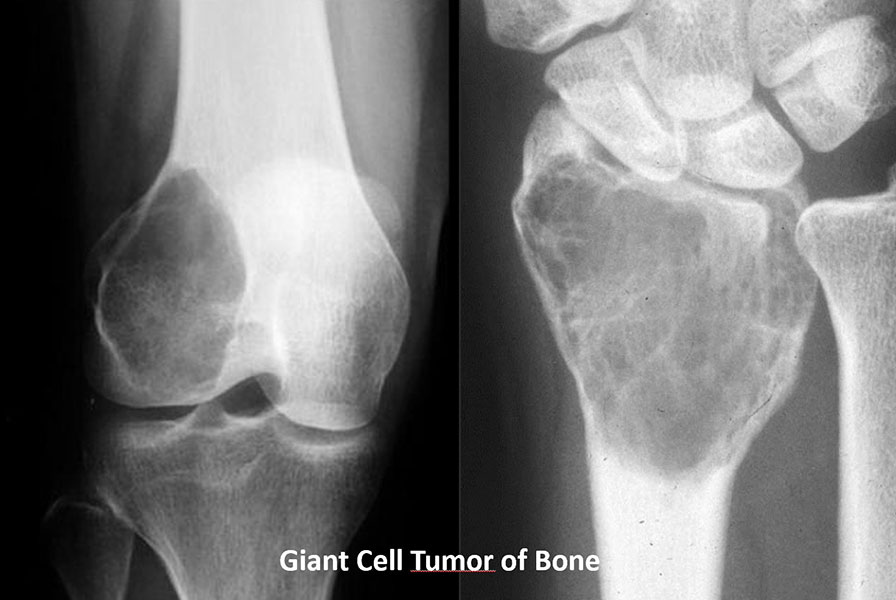 Giant cell tumor at common locations Giant cell tumor at common locations