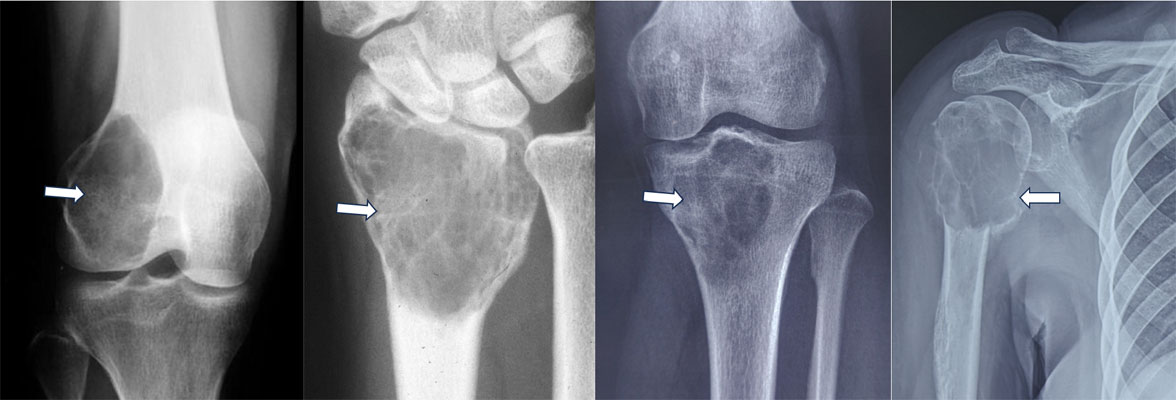 Giant cell tumor of bone can occur in different locations, commonly around the knee, wrist and shoulder Giant cell tumor of bone can occur in different locations, commonly around the knee, wrist and shoulder