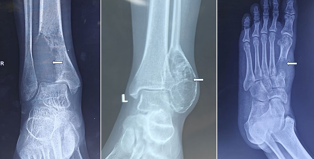 Giant cell tumor of the ankle—a locally aggressive bone tumor requiring specialized treatment Giant cell tumor of the ankle—a locally aggressive bone tumor requiring specialized treatment
