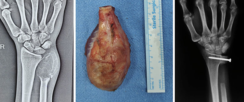 Giant cell tumor of the distal ulna treated with tumor resection Giant cell tumor of the distal ulna treated with tumor resection