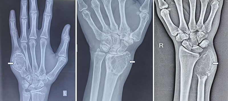 Giant cell tumor of the hand and wrist Giant cell tumor of the hand and wrist