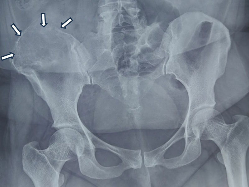 Giant cell tumor of the pelvis involving the iliac bone, shown on X-ray and MRI Giant cell tumor of the pelvis involving the iliac bone, shown on X-ray and MRI