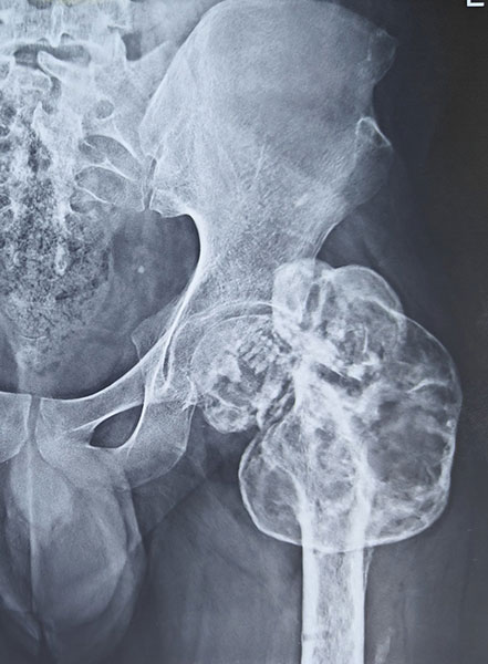 Giant cell tumor of the proximal femur involving the hip, with a large destructive bone lesion Giant cell tumor of the proximal femur involving the hip, with a large destructive bone lesion