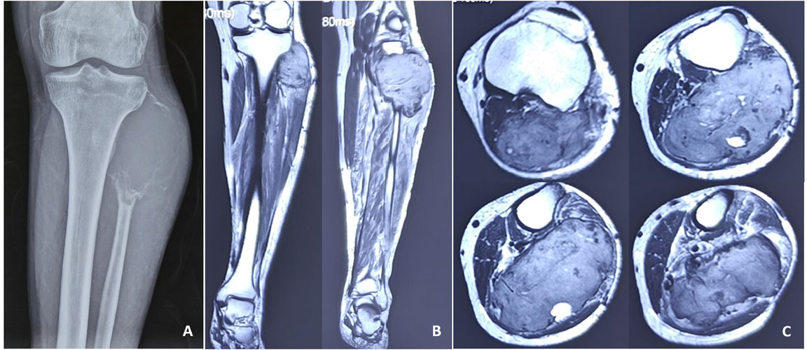 Giant cell tumor of the upper fibula
