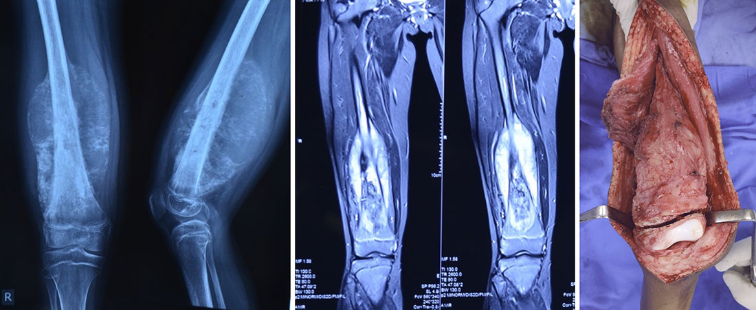 Growth plate-sparing surgery for osteosarcoma
