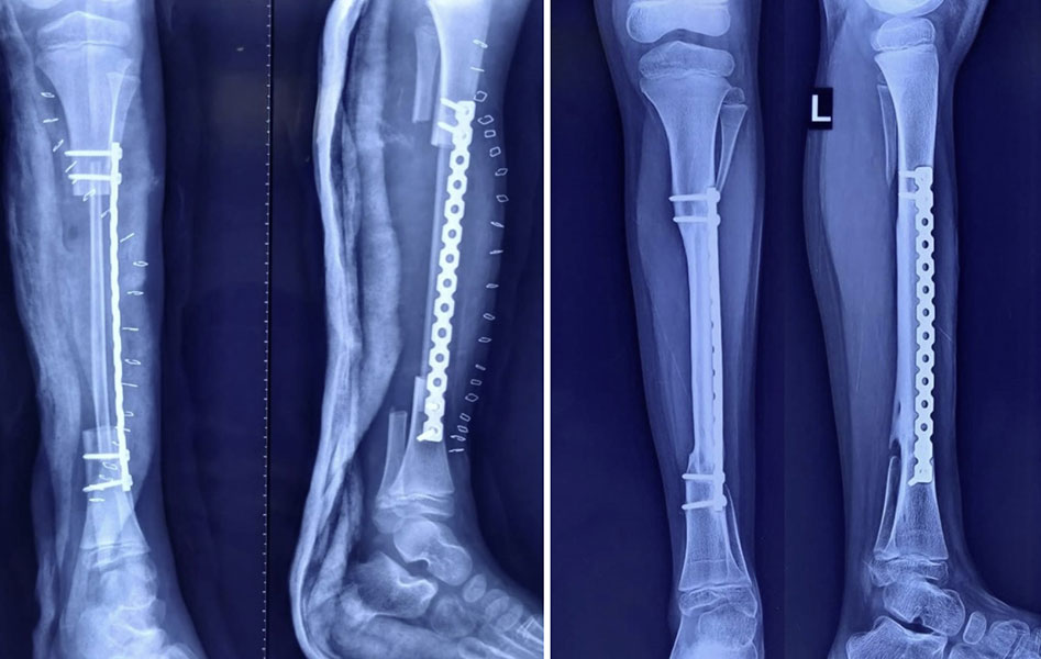 Healing after vascularized fibula reconstruction